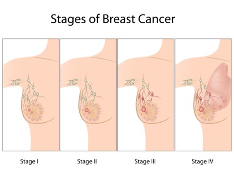 Intracavitary Brachytherapy for Breast Cancer by OrangeCountySurgeons 